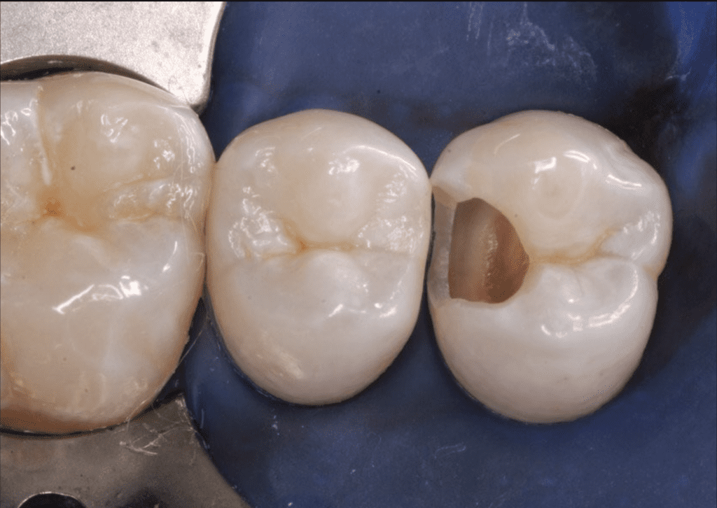 ausgebohrter Zahn