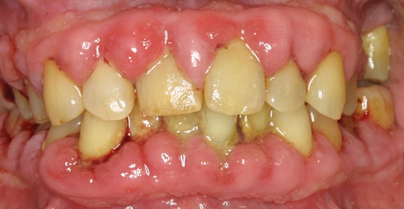 Bild 1: Schwere chronische Parodontitis mit Gingivawucherungen bei manifestem Diabetes mellitus Typ 2 (Bildquelle: Dr. V. Lemkamp)