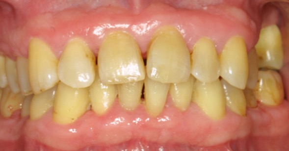 Bild 2: Zustand 1 Jahr nach systematischer antiinfektiöser Therapie ohne jegliche parodontalchirurgischen Eingriffe (Bildquelle: Dr. V. Lemkamp)